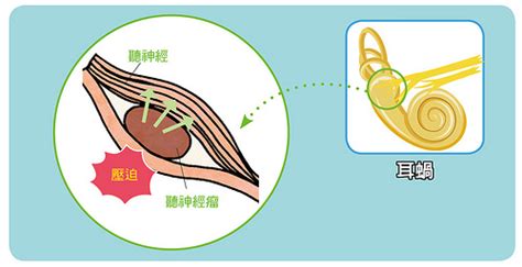 左耳一直有聲音|耳鳴 ：發生的症狀、造成的原因、如何診斷與治療方。